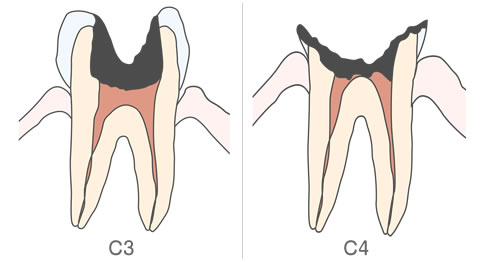 虫歯の進行、C3とC4のイラスト解説